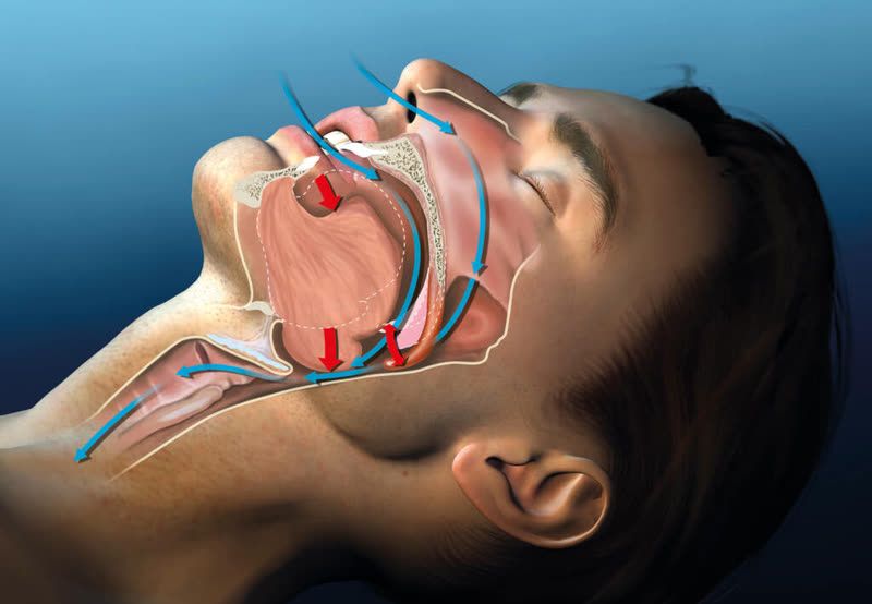 Sleep apnea systemic impact: heart and brain